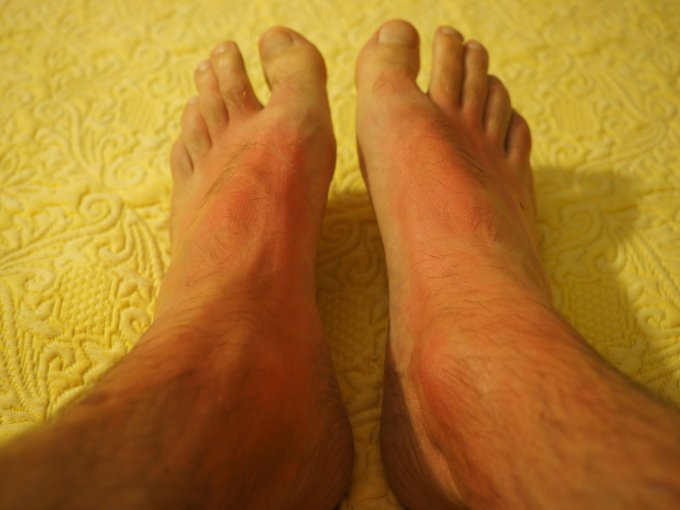 stopy po oparzeniu słonecznym